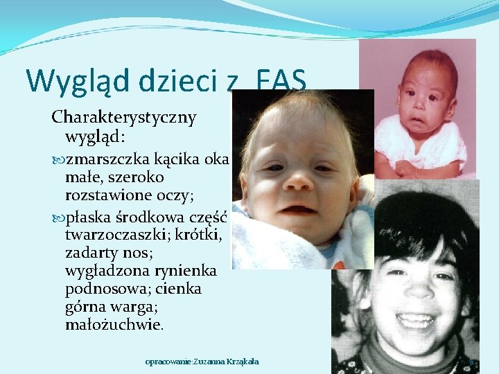 Wygląd dzieci z FAS Charakterystyczny wygląd: zmarszczka kącika oka; małe, szeroko rozstawione oczy; płaska