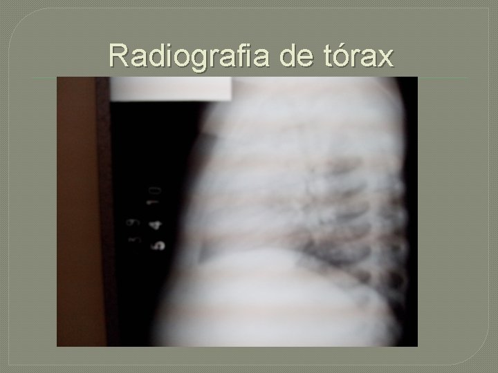 Radiografia de tórax 