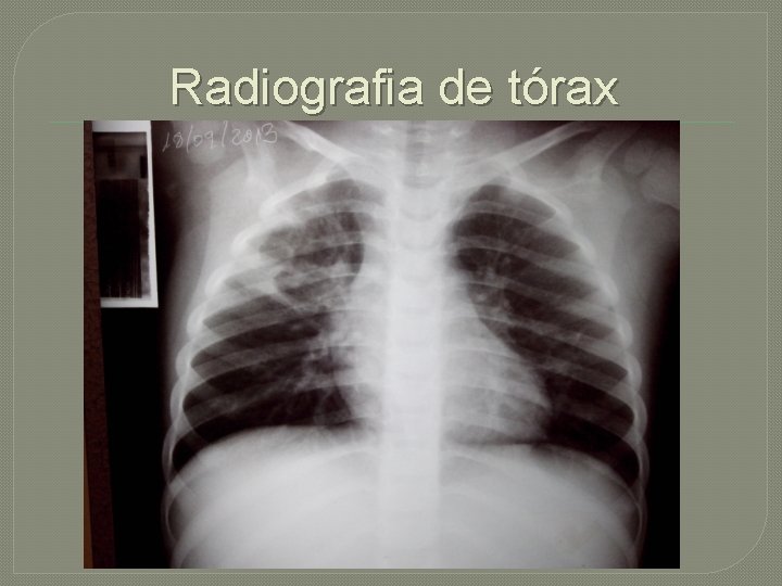 Radiografia de tórax 