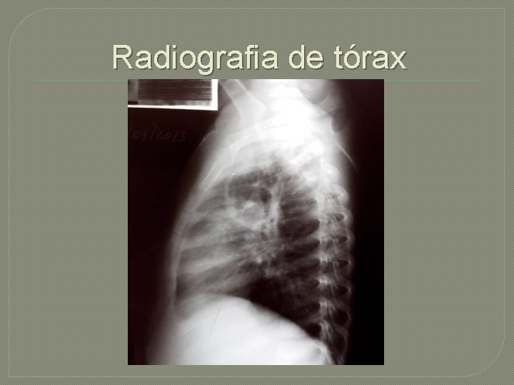 Radiografia de tórax 