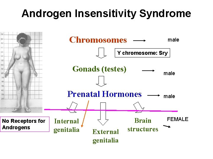 Androgen Insensitivity Syndrome Chromosomes male Y chromosome: Sry Gonads (testes) male Prenatal Hormones No