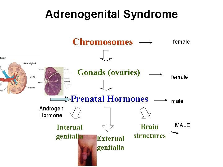 Adrenogenital Syndrome Chromosomes female Gonads (ovaries) Prenatal Hormones female Androgen Hormone Internal genitalia External