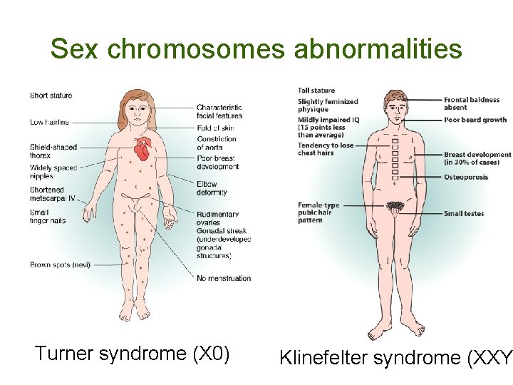 Sex chromosomes abnormalities Turner syndrome (X 0) Klinefelter syndrome (XXY 