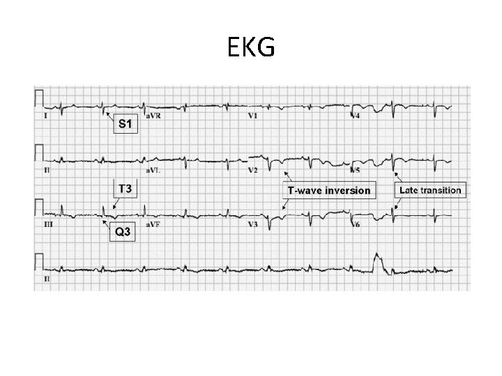 EKG 