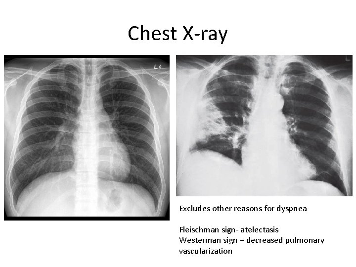 Chest X-ray Excludes other reasons for dyspnea Fleischman sign- atelectasis Westerman sign – decreased