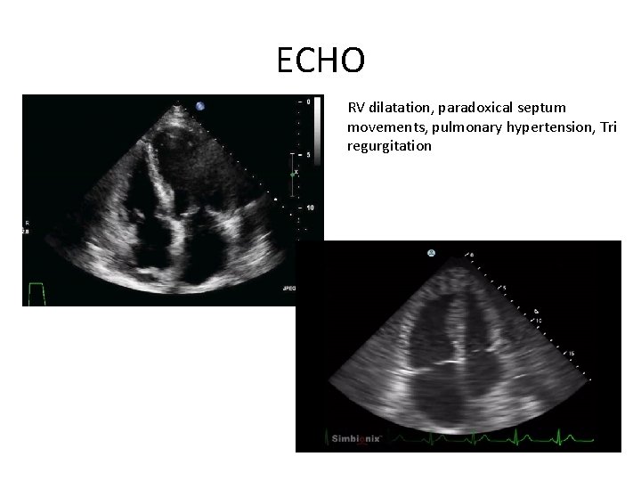 ECHO RV dilatation, paradoxical septum movements, pulmonary hypertension, Tri regurgitation 