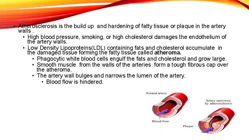  • Atherosclerosis is the build up and hardening of fatty tissue or plaque