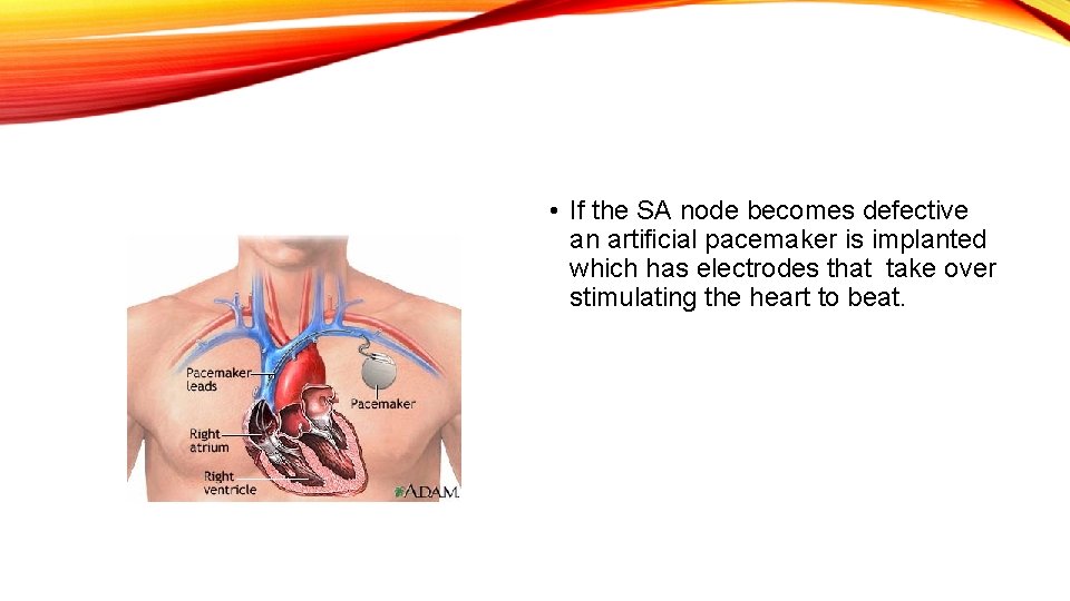  • If the SA node becomes defective an artificial pacemaker is implanted which