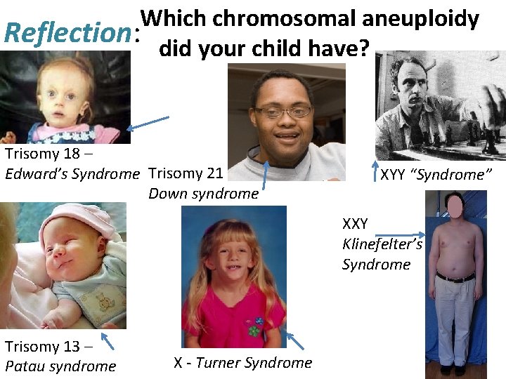 Which chromosomal aneuploidy Reflection: did your child have? Trisomy 18 – Edward’s Syndrome Trisomy