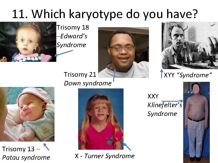 11. Which karyotype do you have? Trisomy 18 –Edward’s Syndrome Trisomy 21 Down syndrome