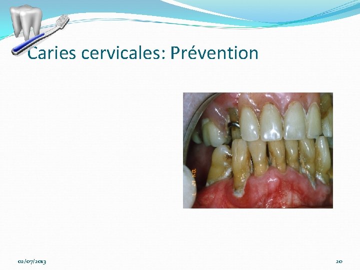 Caries cervicales: Prévention 02/07/2013 20 