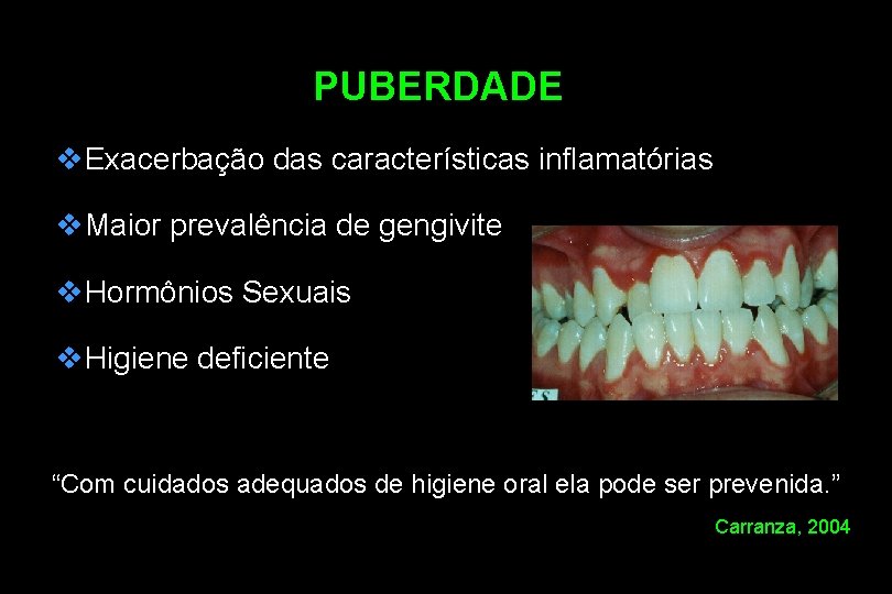 PUBERDADE v. Exacerbação das características inflamatórias v. Maior prevalência de gengivite v. Hormônios Sexuais