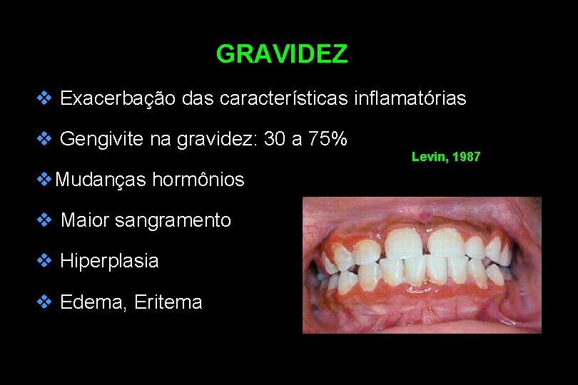 GRAVIDEZ v Exacerbação das características inflamatórias v Gengivite na gravidez: 30 a 75% v.