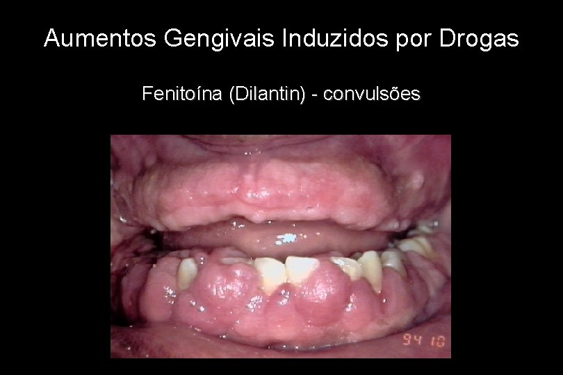 Aumentos Gengivais Induzidos por Drogas Fenitoína (Dilantin) - convulsões 