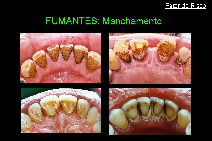 Fator de Risco FUMANTES: Manchamento 