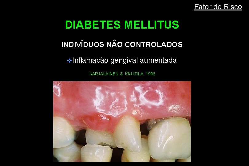 Fator de Risco DIABETES MELLITUS INDIVÍDUOS NÃO CONTROLADOS v. Inflamação gengival aumentada KARJALAINEN &