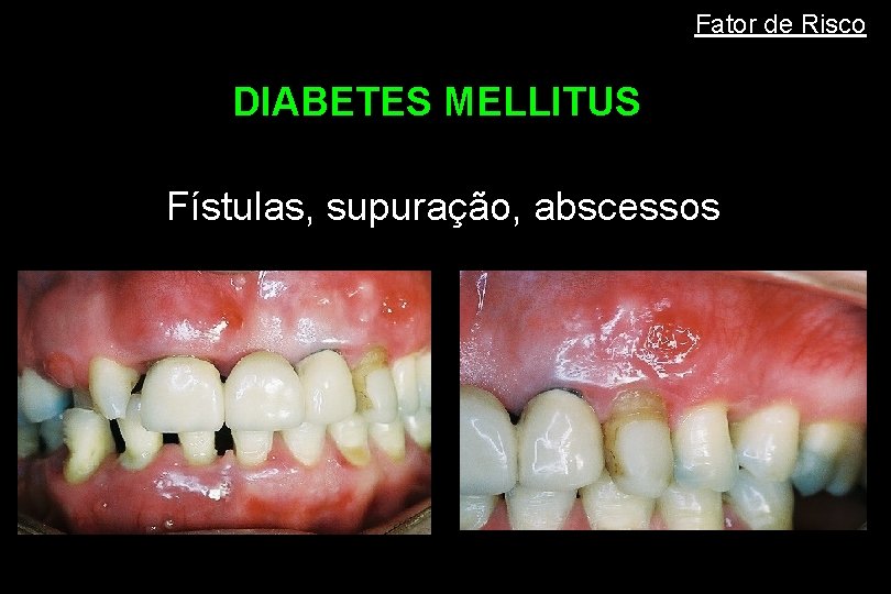 Fator de Risco DIABETES MELLITUS Fístulas, supuração, abscessos 