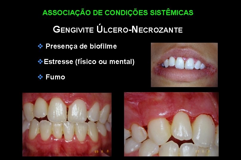 ASSOCIAÇÃO DE CONDIÇÕES SISTÊMICAS GENGIVITE ÚLCERO-NECROZANTE v Presença de biofilme v. Estresse (físico ou