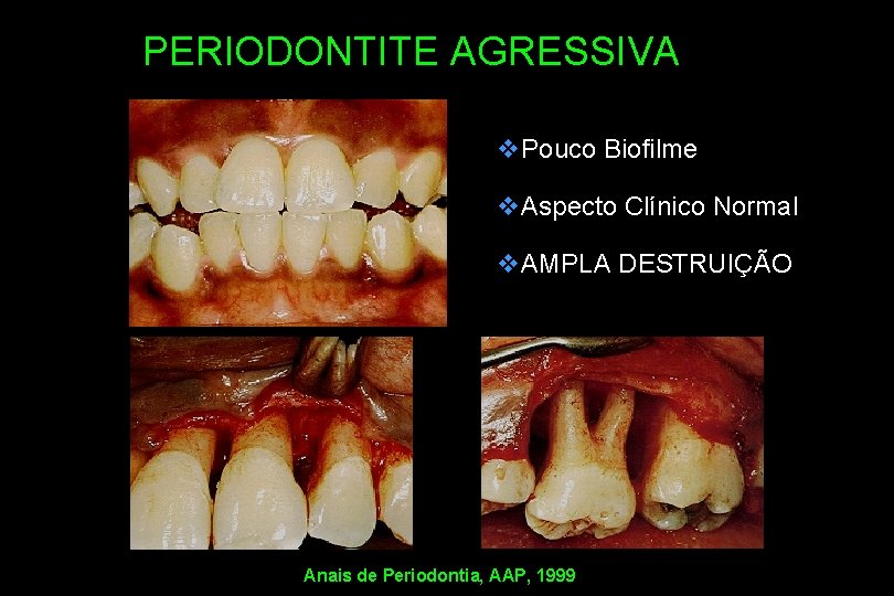 PERIODONTITE AGRESSIVA v. Pouco Biofilme v. Aspecto Clínico Normal v. AMPLA DESTRUIÇÃO Anais de