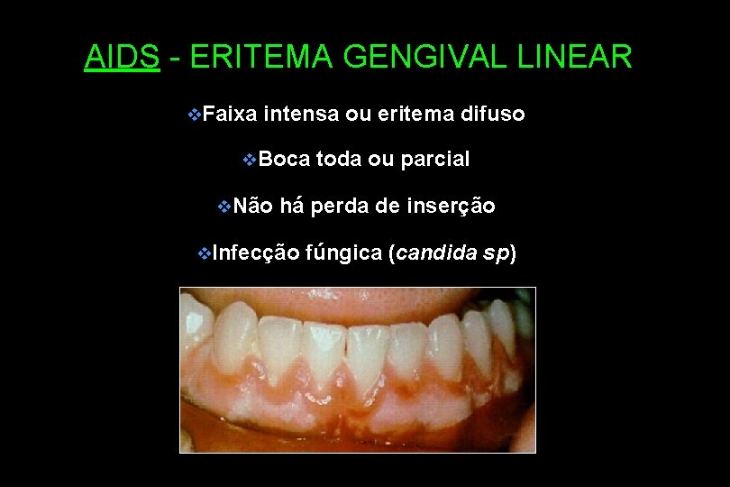 AIDS - ERITEMA GENGIVAL LINEAR v. Faixa intensa ou eritema difuso v. Boca v.