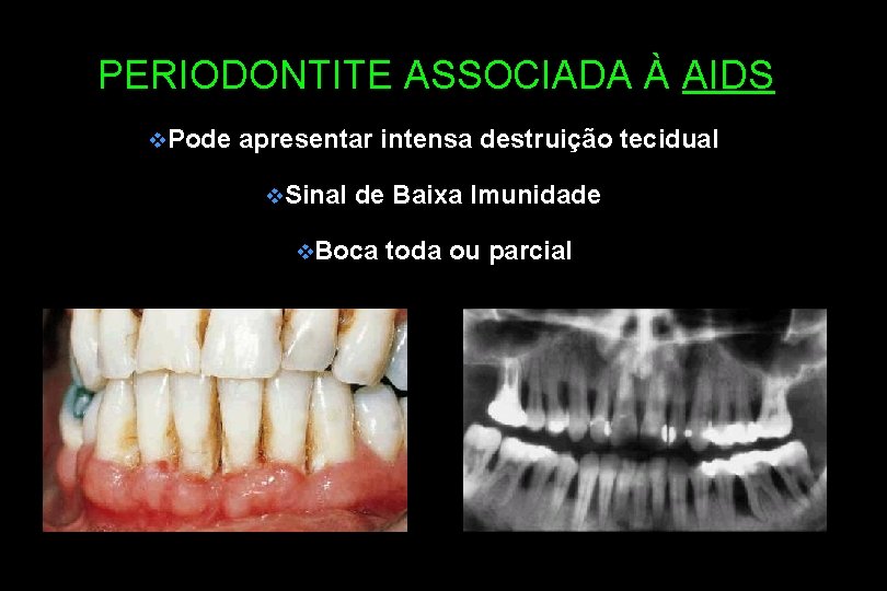 PERIODONTITE ASSOCIADA À AIDS v. Pode apresentar intensa destruição tecidual v. Sinal de Baixa