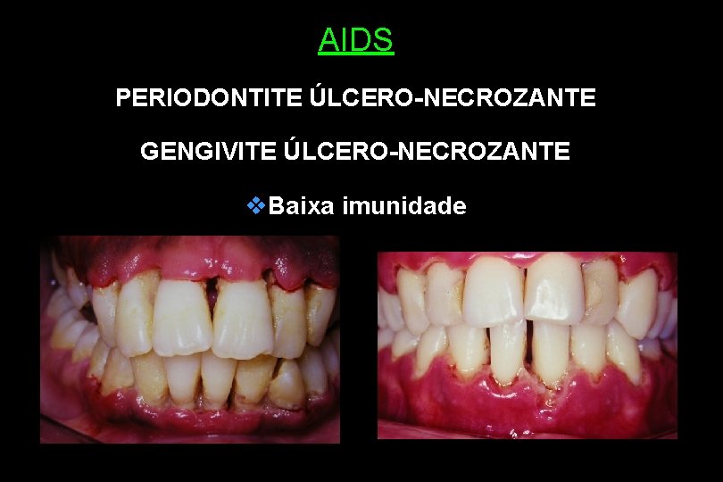 AIDS PERIODONTITE ÚLCERO-NECROZANTE GENGIVITE ÚLCERO-NECROZANTE v. Baixa imunidade 