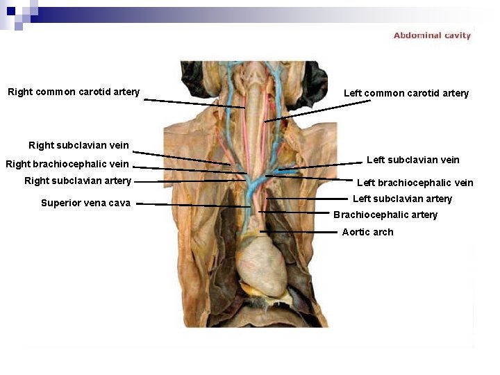 Right common carotid artery Left common carotid artery Right subclavian vein Right brachiocephalic vein