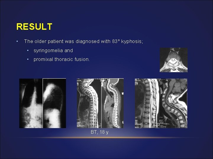 RESULT • The older patient was diagnosed with 83° kyphosis; • syringomelia and •