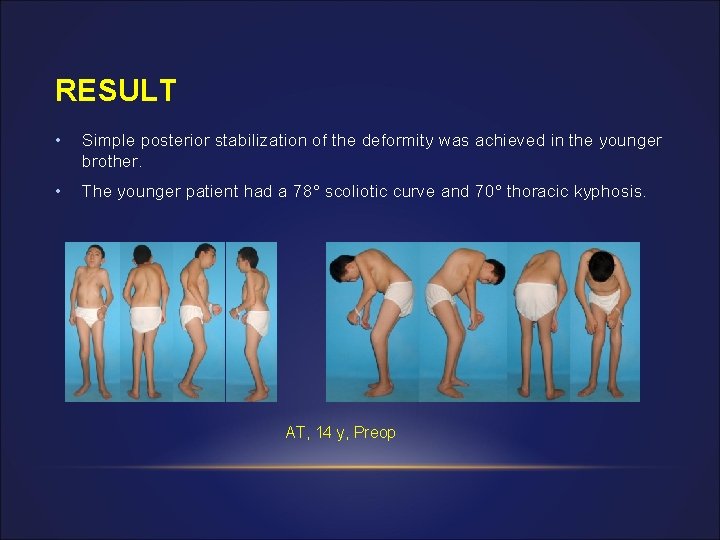RESULT • Simple posterior stabilization of the deformity was achieved in the younger brother.