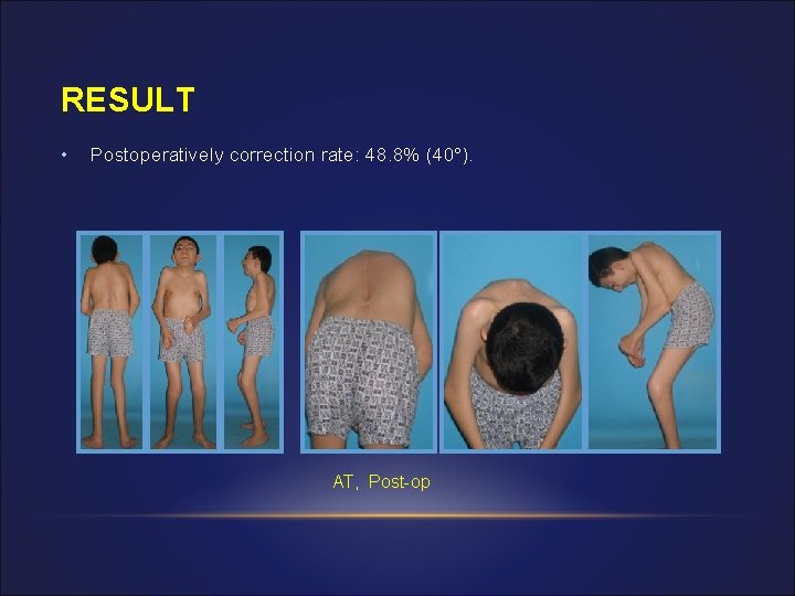 RESULT • Postoperatively correction rate: 48. 8% (40°). AT, Post-op 
