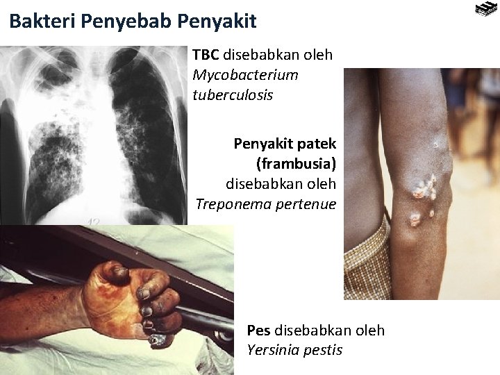 Bakteri Penyebab Penyakit TBC disebabkan oleh Mycobacterium tuberculosis Penyakit patek (frambusia) disebabkan oleh Treponema