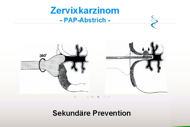 Zervixkarzinom - PAP-Abstrich - Sekundäre Prevention 