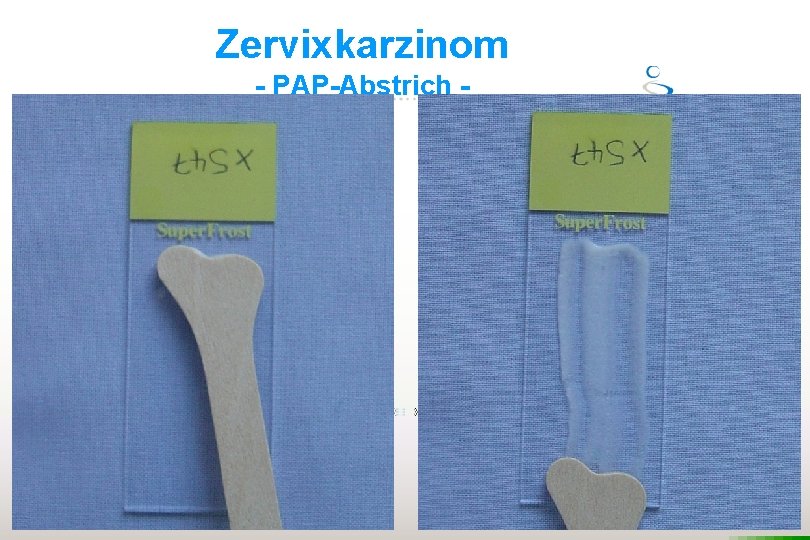 Zervixkarzinom - PAP-Abstrich - 