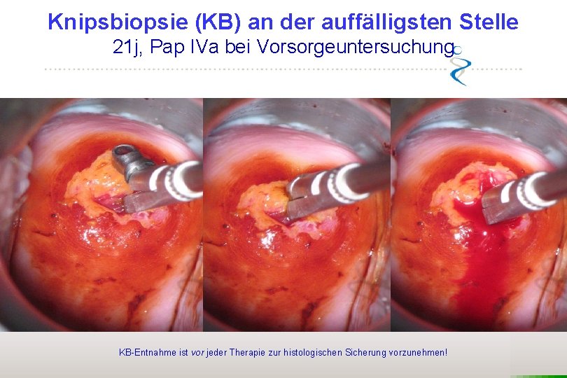 Knipsbiopsie (KB) an der auffälligsten Stelle 21 j, Pap IVa bei Vorsorgeuntersuchung Endozervikaler Rand