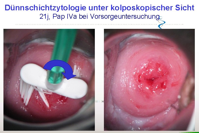 Dünnschichtzytologie unter kolposkopischer Sicht 21 j, Pap IVa bei Vorsorgeuntersuchung 