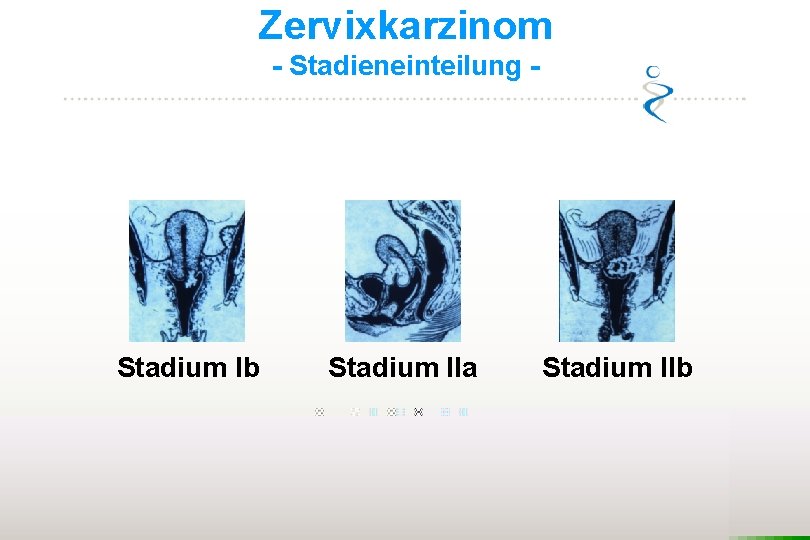 Zervixkarzinom - Stadieneinteilung - Stadium Ib Stadium IIa Stadium IIb 