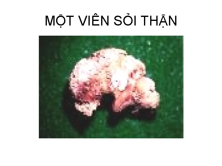 MỘT VIÊN SỎI THẬN 