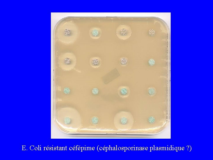 E. Coli résistant céfépime (céphalosporinase plasmidique ? ) 