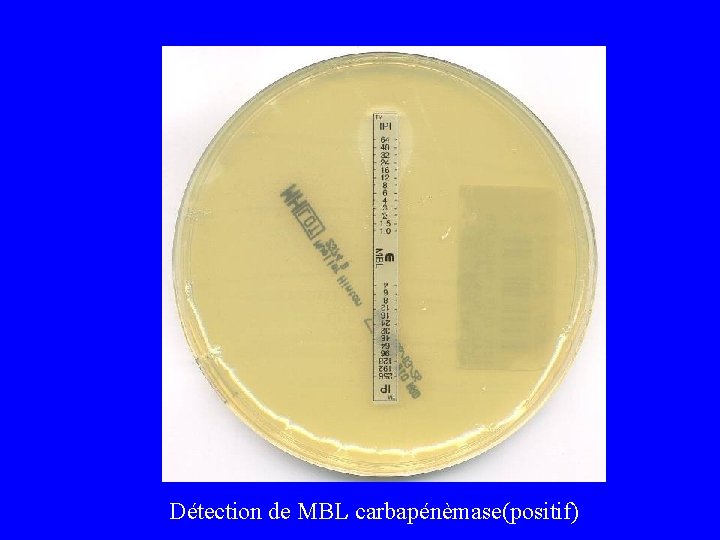  Détection de MBL carbapénèmase(positif) 