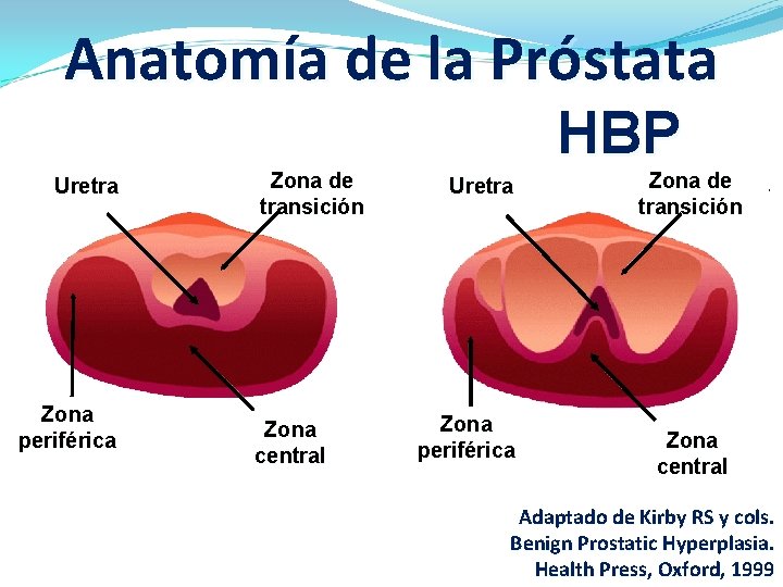 Anatomía de la Próstata Uretra Zona periférica Zona de transición Zona central HBP Uretra