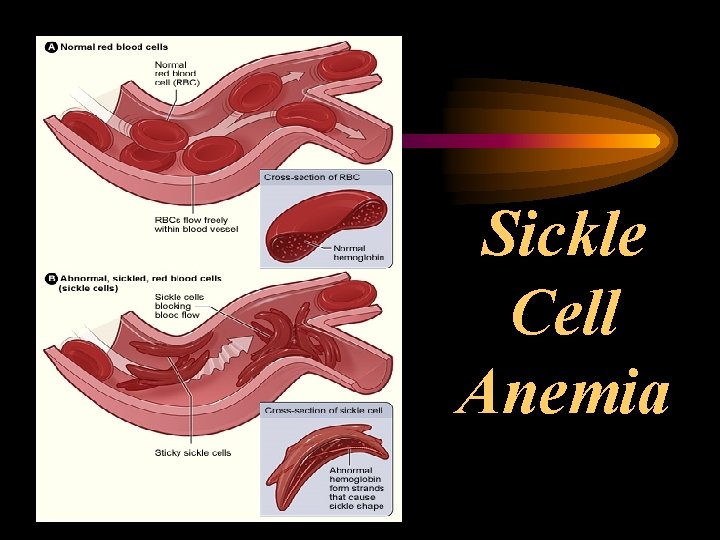 Sickle Cell Anemia 