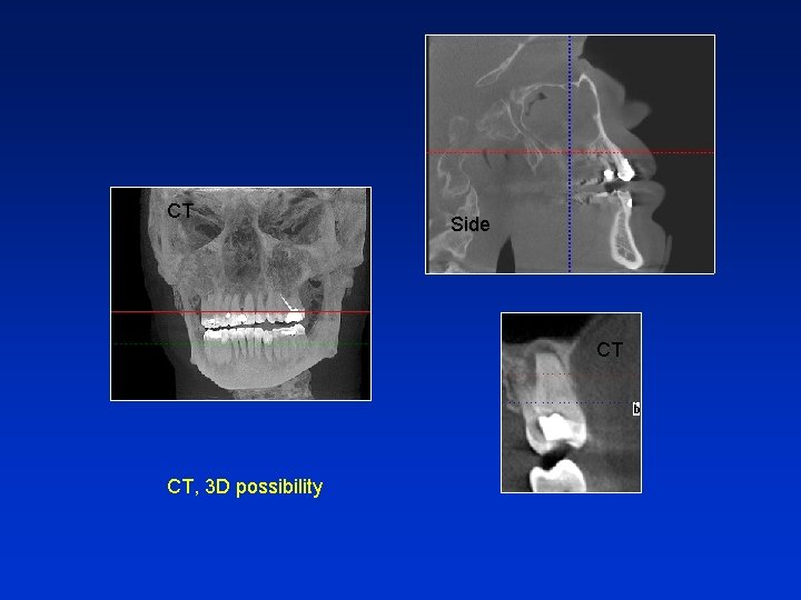 CT Side CT CT, 3 D possibility 