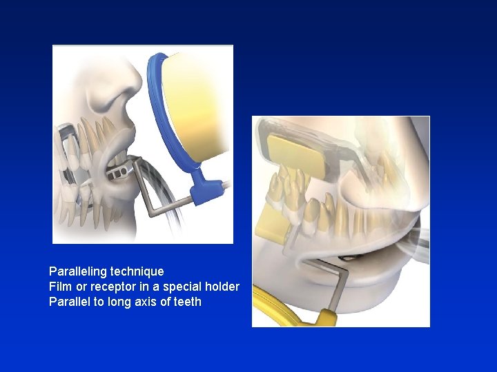 Paralleling technique Film or receptor in a special holder Parallel to long axis of