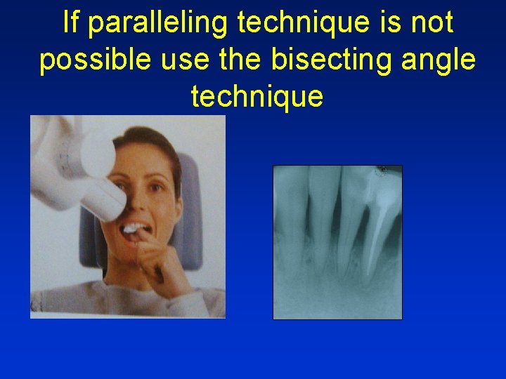 If paralleling technique is not possible use the bisecting angle technique If paralleling technique is not possible use the bisecting angle technique