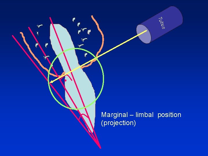 us Tub Marginal – limbal position (projection) 