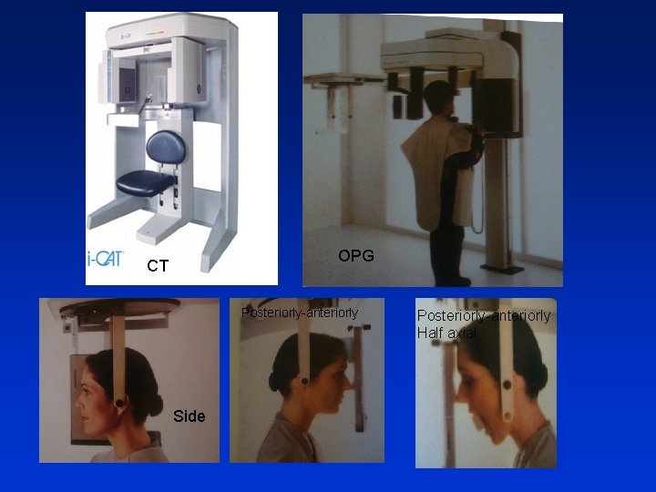 OPG CT Posteriorly-anteriorly Side Posteriorly-anteriorly Half axial 