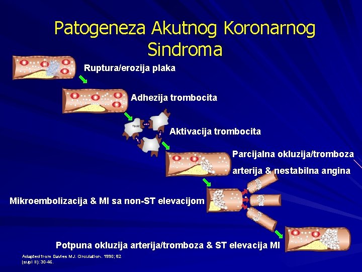 Patogeneza Akutnog Koronarnog Sindroma Ruptura/erozija plaka Adhezija trombocita Aktivacija trombocita Parcijalna okluzija/tromboza arterija &