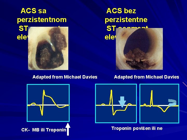 ACS sa perzistentnom ST-segment elevacijom Adapted from Michael Davies CK- MB ili Troponin ACS