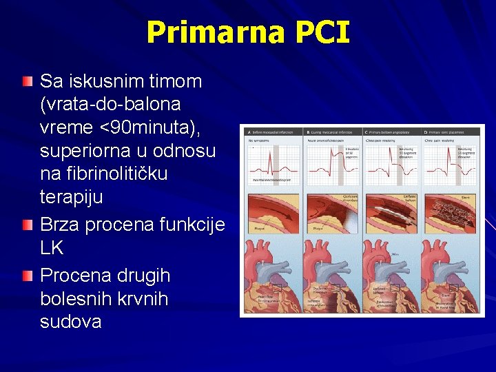 Primarna PCI Sa iskusnim timom (vrata-do-balona vreme <90 minuta), superiorna u odnosu na fibrinolitičku