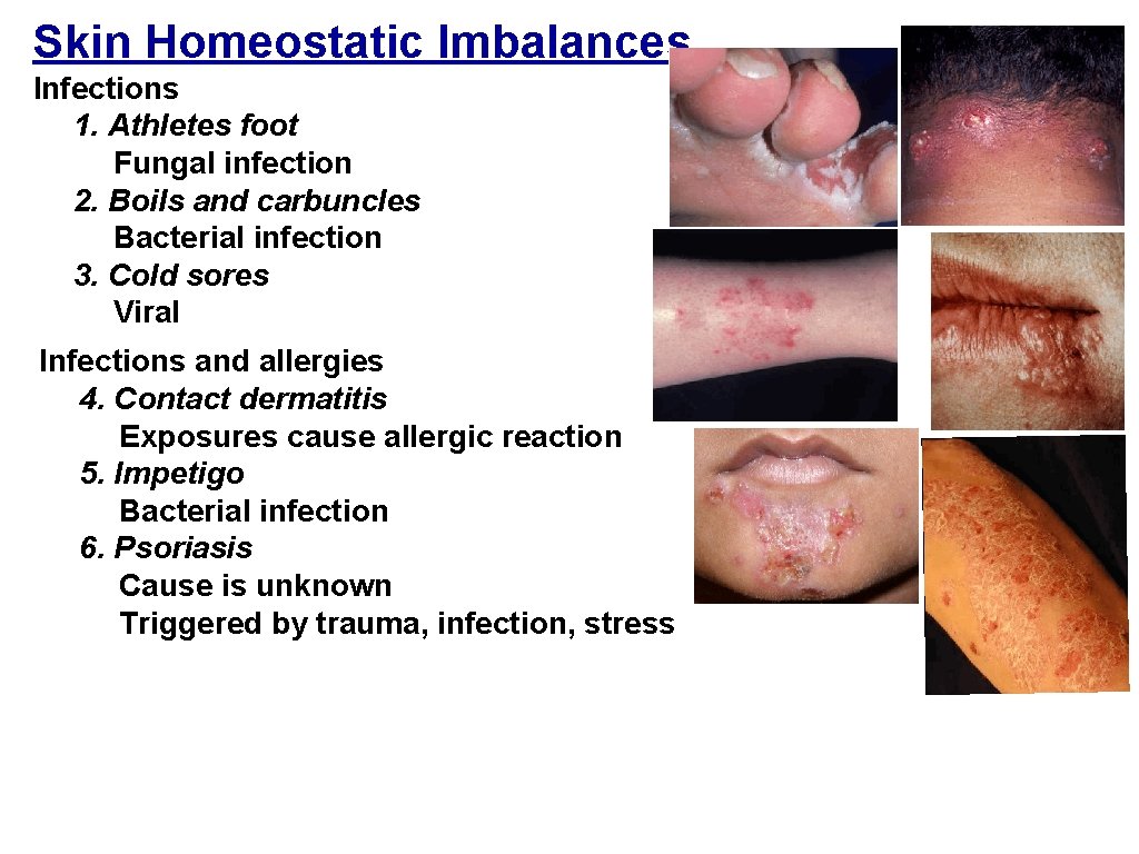 Skin Homeostatic Imbalances Infections 1. Athletes foot Fungal infection 2. Boils and carbuncles Bacterial